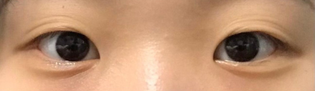 [眼睛] 草莓給我 - 開眼頭、眼型矯正