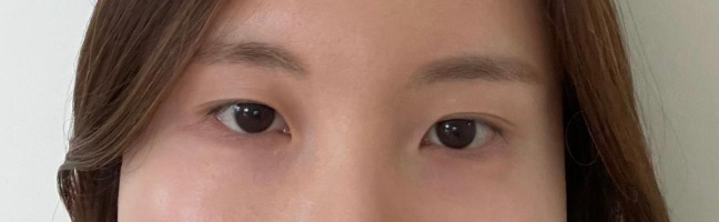 [眼睛] wyn - 開眼頭、眼型矯正