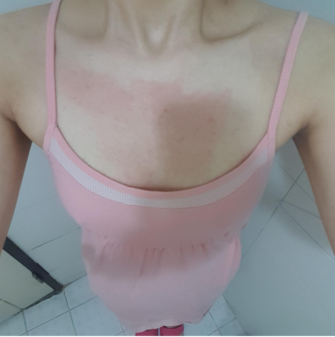 [隆胸] 肉쌈 - 胸部