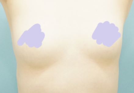 [隆胸] Ocean From The Blue - 胸部