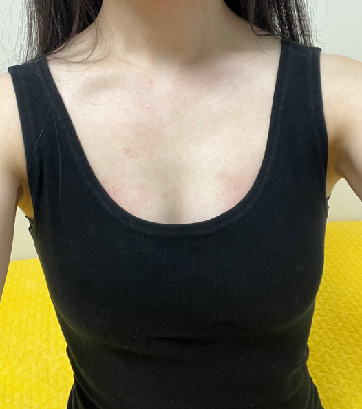 [隆胸] 綠茶松伊 - 隆胸