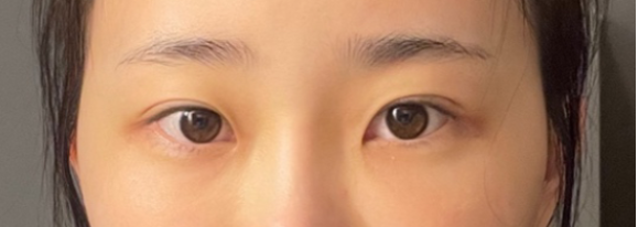 [眼部] 聽說了 - 眼部整形