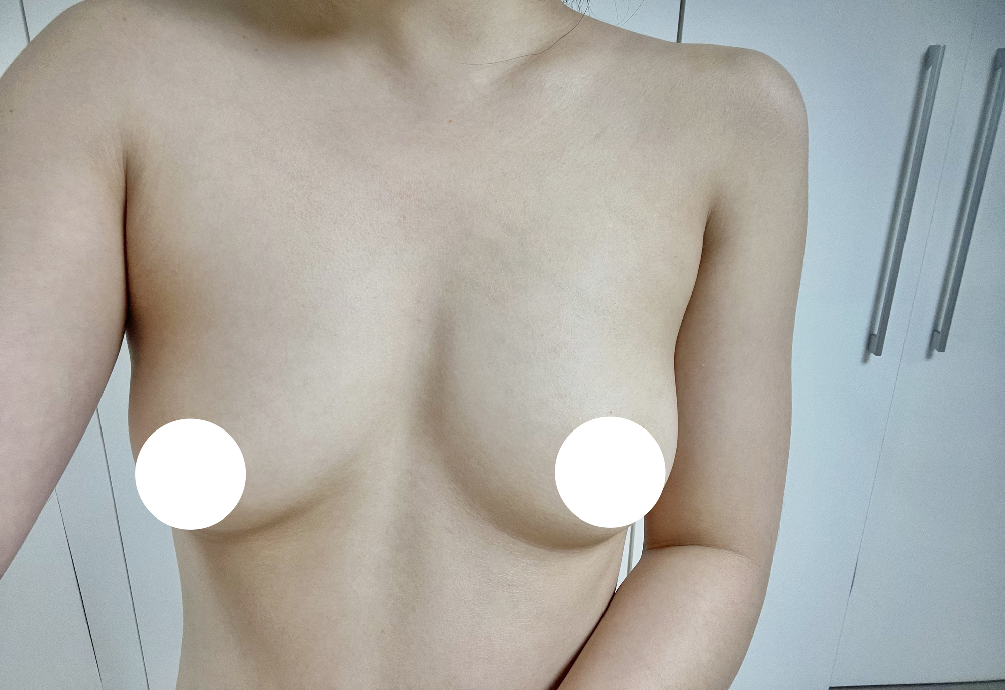 [隆胸] gigigigi - 胸部