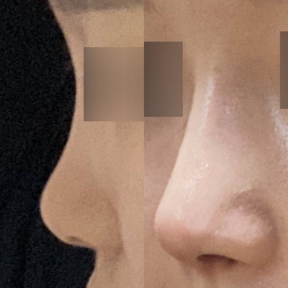 在Weavers做了第一次鼻子手術