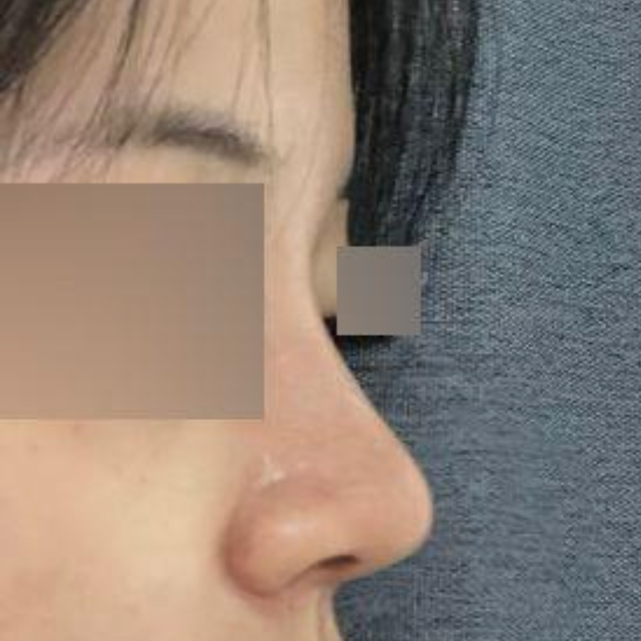 維沃斯整形外科 鼻部手術一個月後記