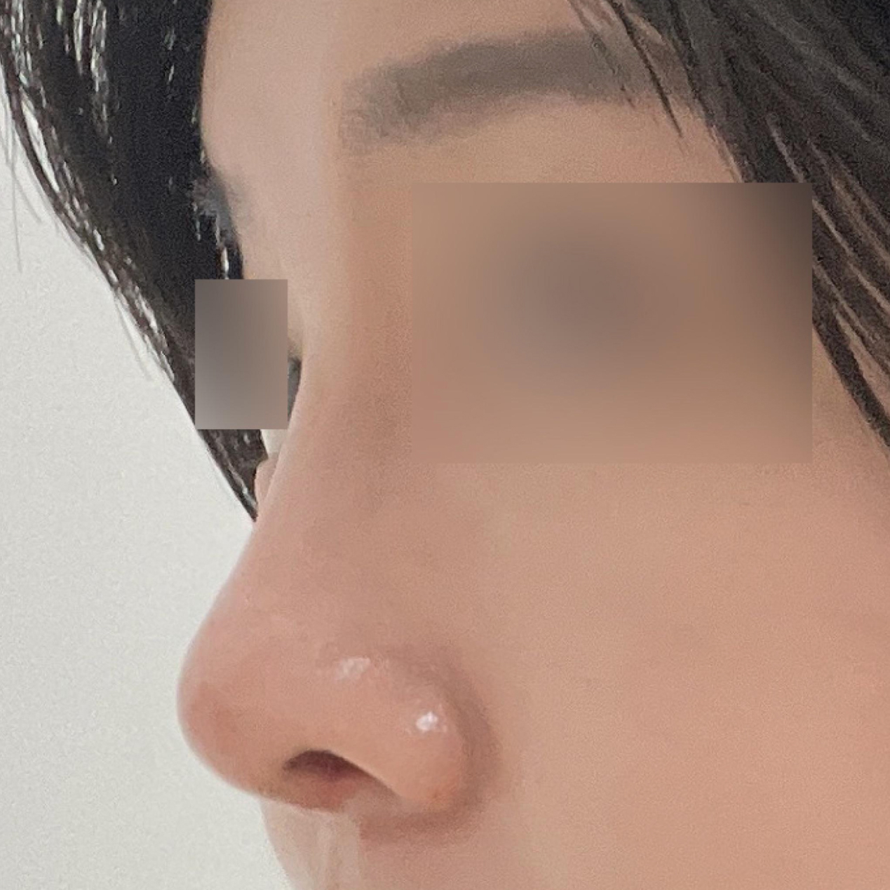 做了朝天鼻手術~! 