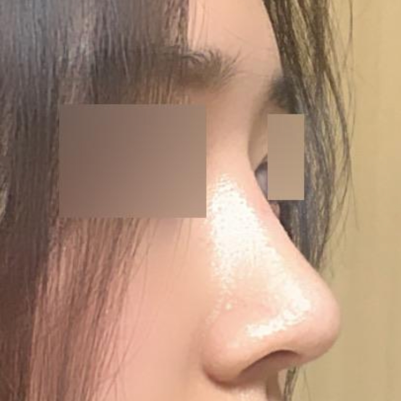 做了不對稱和蒜頭鼻矯正