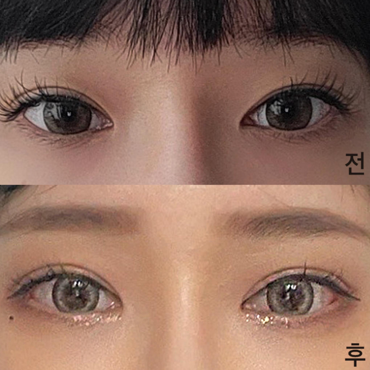 做完眼部修復手術已經兩個月左右了ㅎ