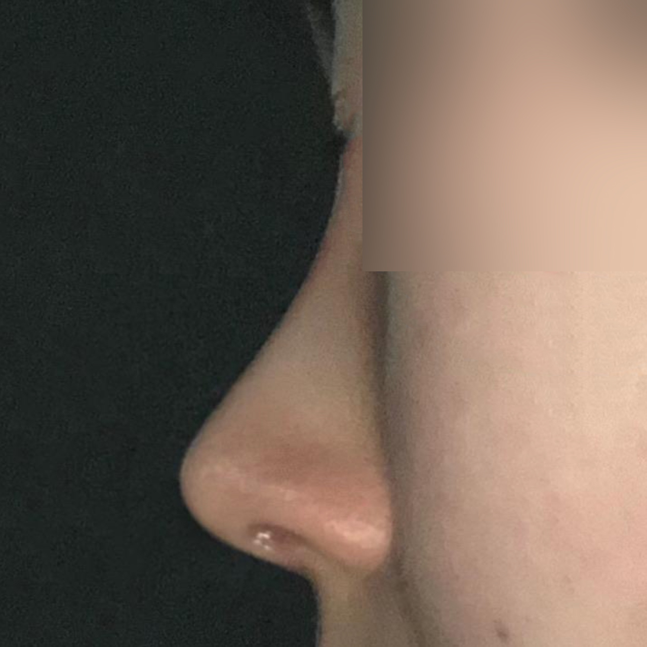 給Wievers整形外科徐承祖院長做完隆鼻手術已經一個月了！