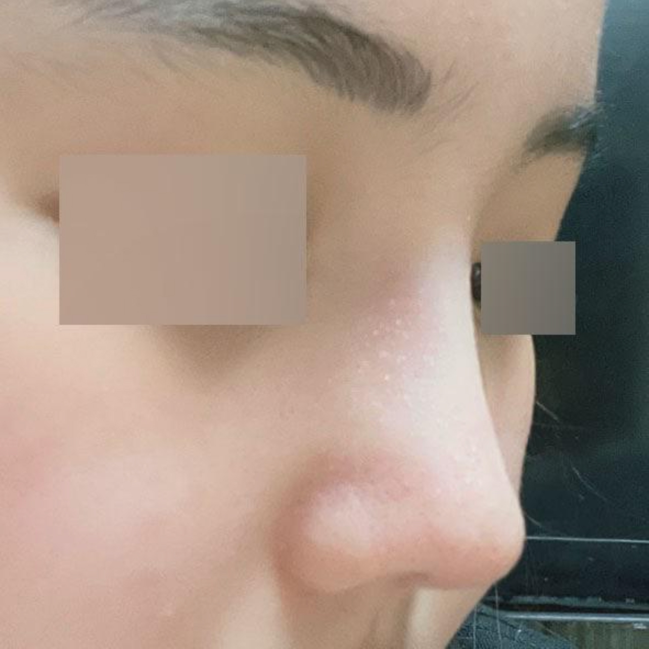 短鼻子+功能性隆鼻手術2個月後記