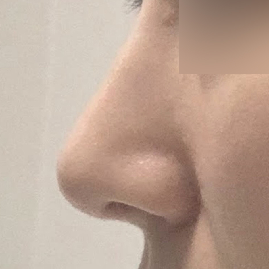 做完隆鼻手術差不多4個月了