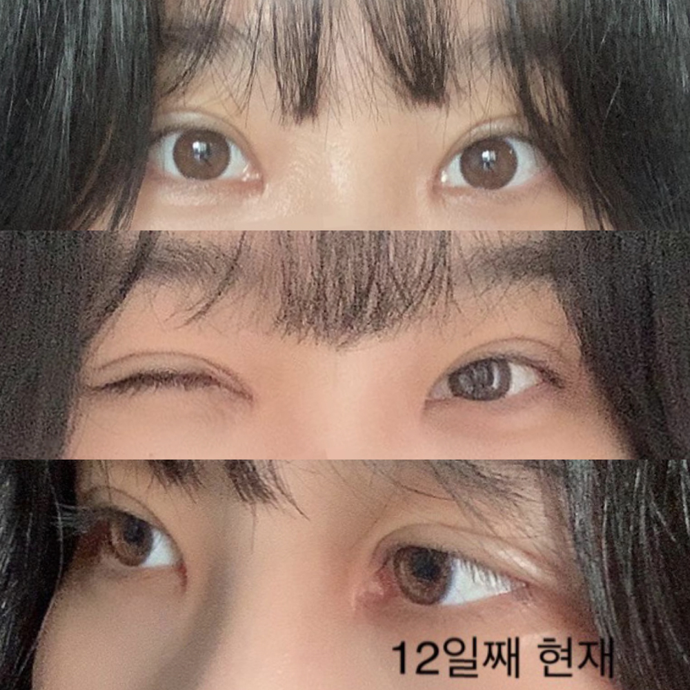 眼部重修手術，非常滿意的真實後記