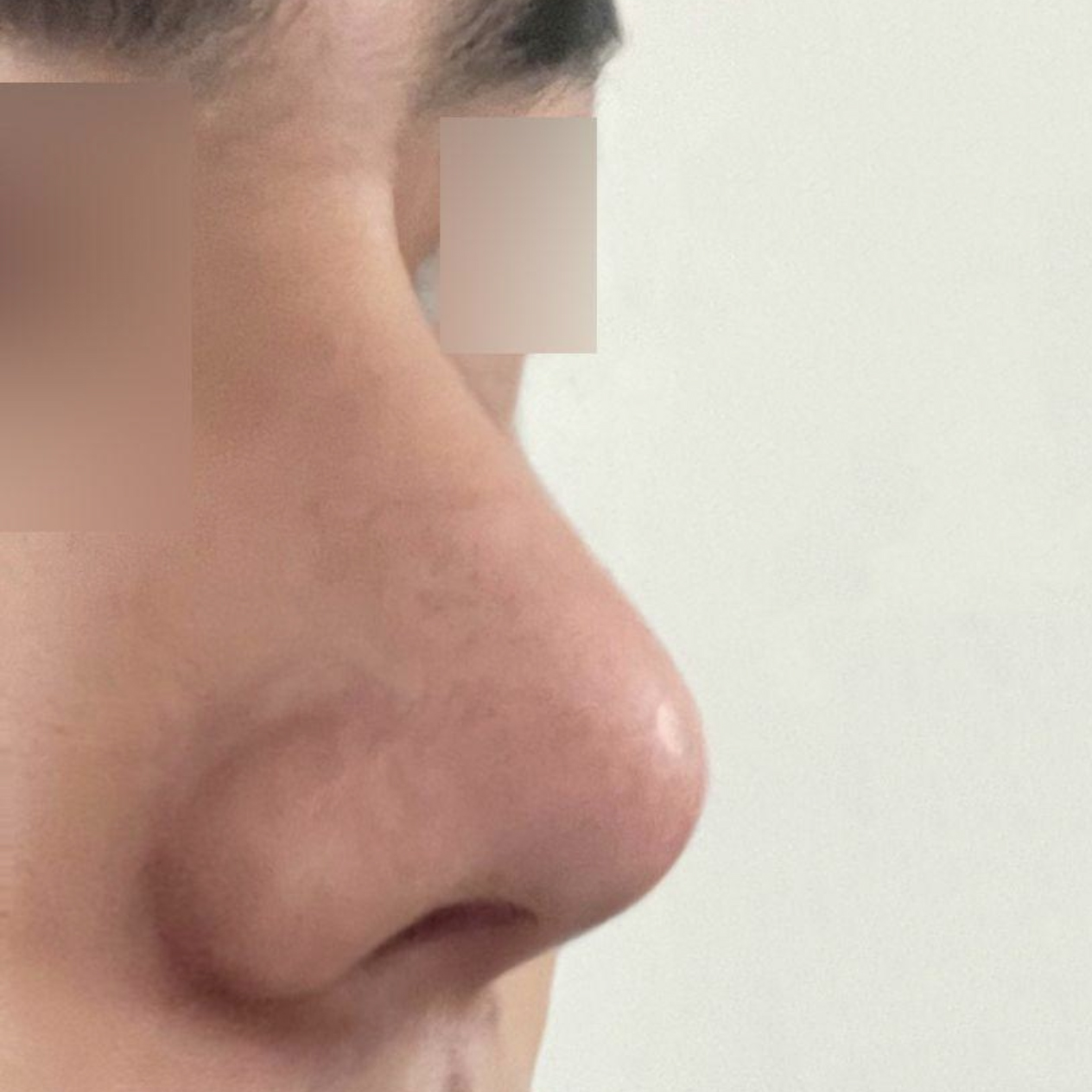 給沈正煥院長做手術已經1個月了。