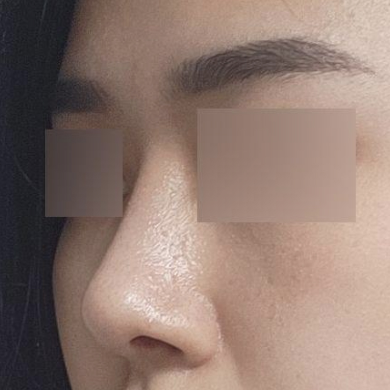 小鼻縮小手術已經2個月了！