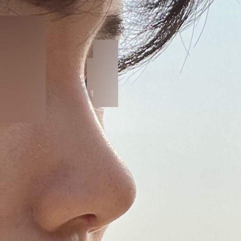 今天終於把裡面的線拆掉了！