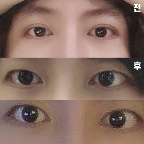 雙眼皮修復降低手術線後的經過