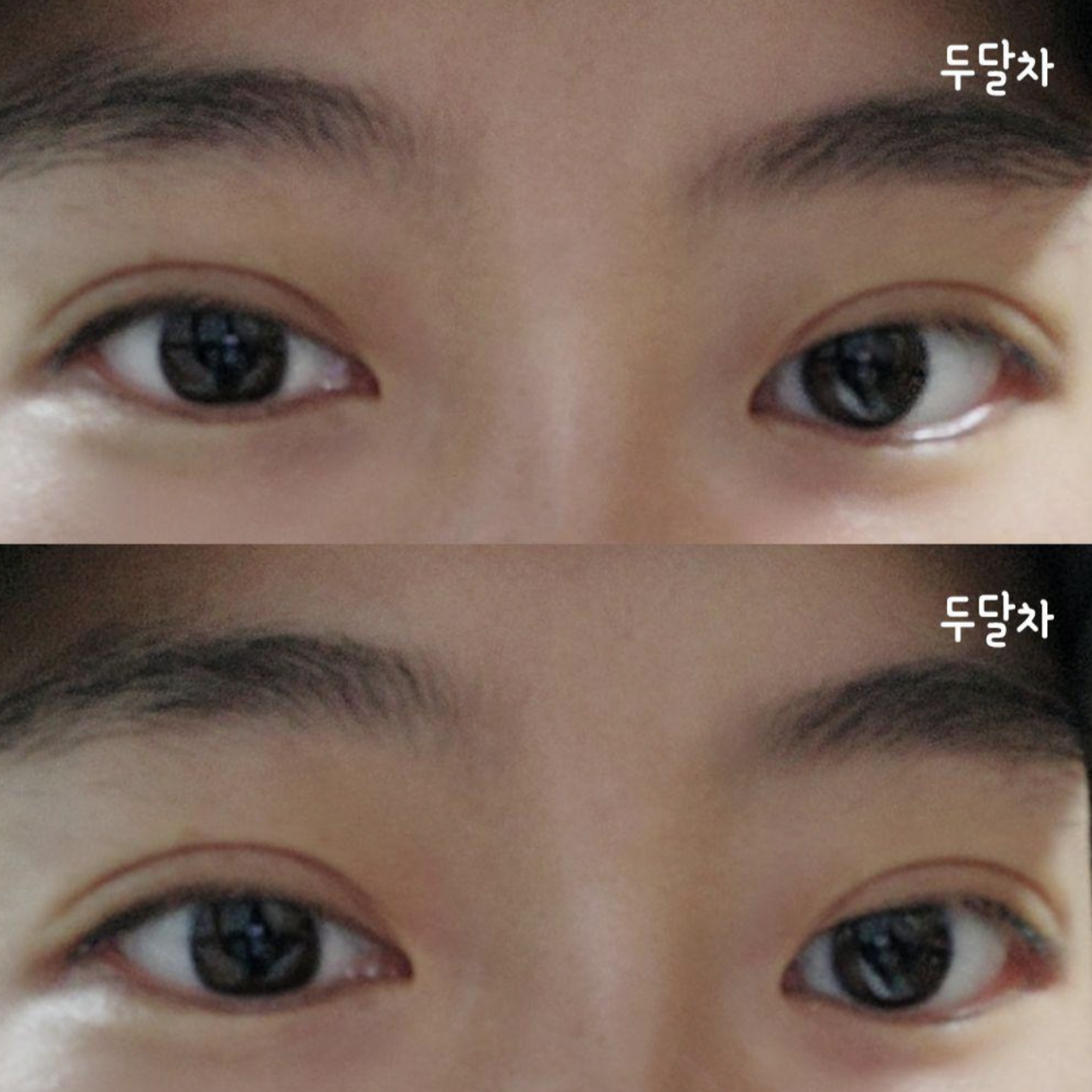 眼部手術兩個月的真實後記~^^