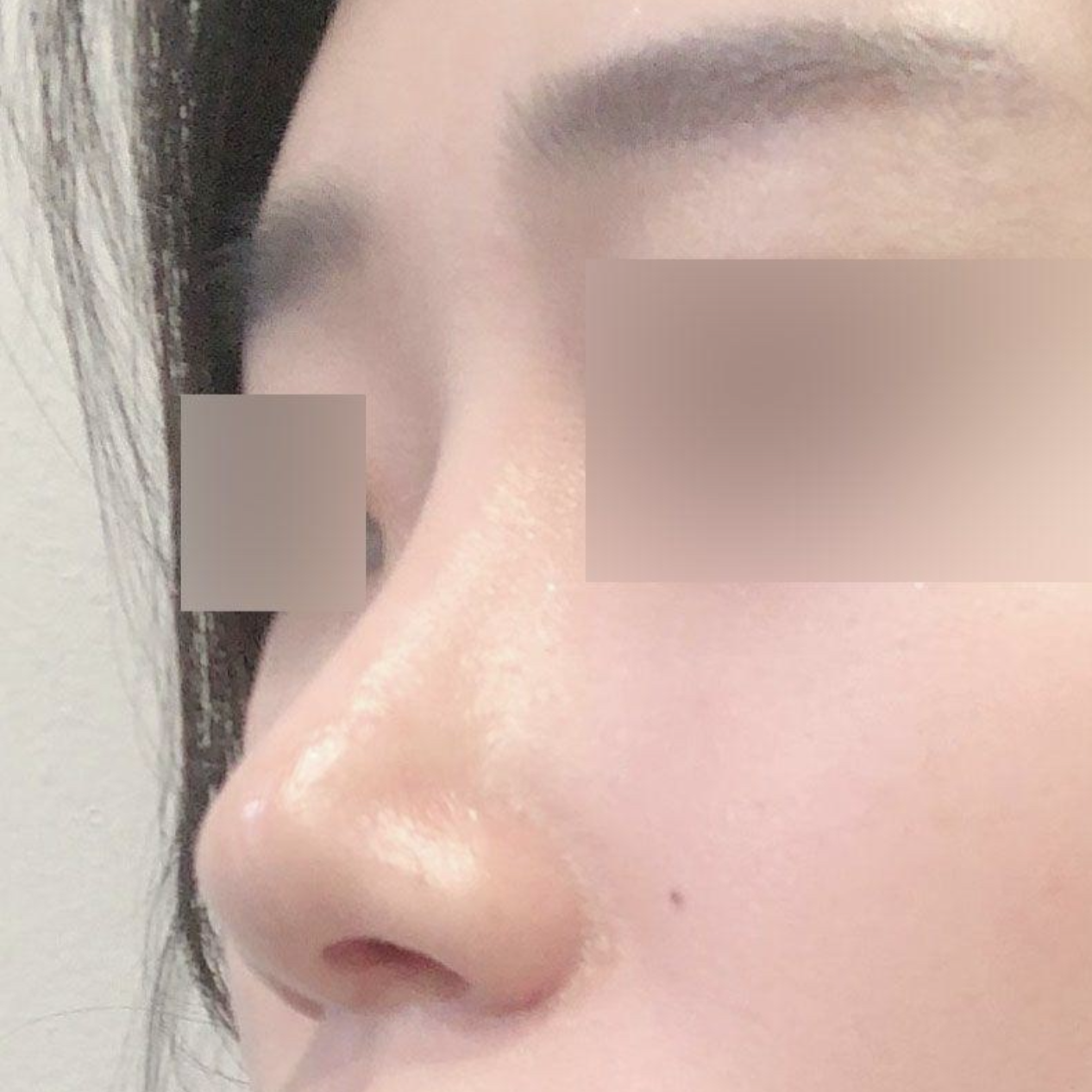 做了縮鼻頭手術已經3個月了！！！