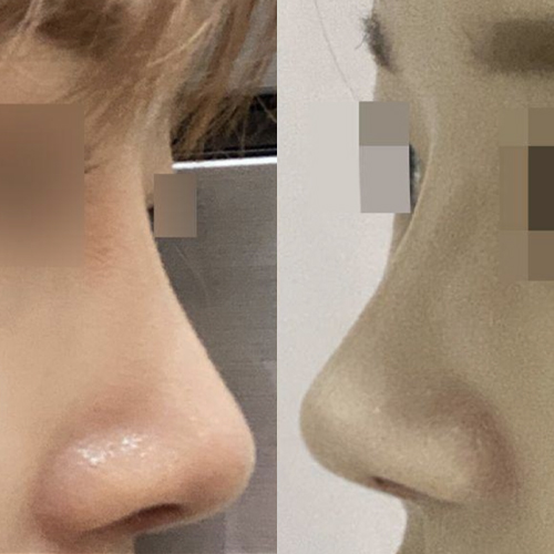 做完隆鼻手術已經三個月了