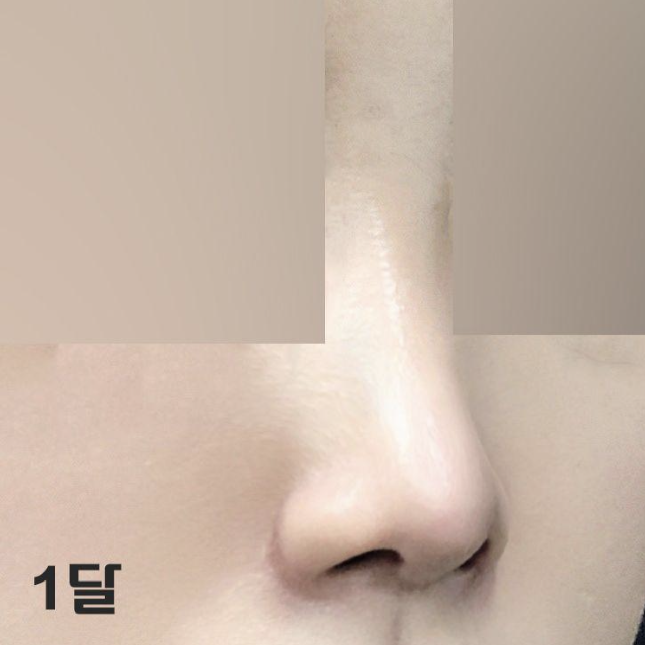 過了一個月，感覺腫脹消退得更快了~