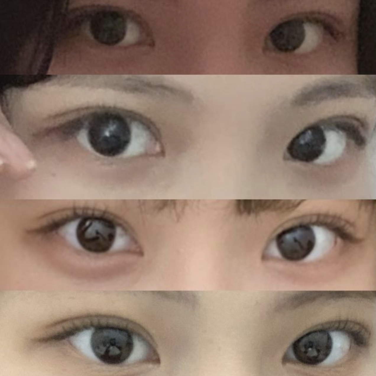 （自然沾黏 眼型矯正 開眼頭）手術後4個月