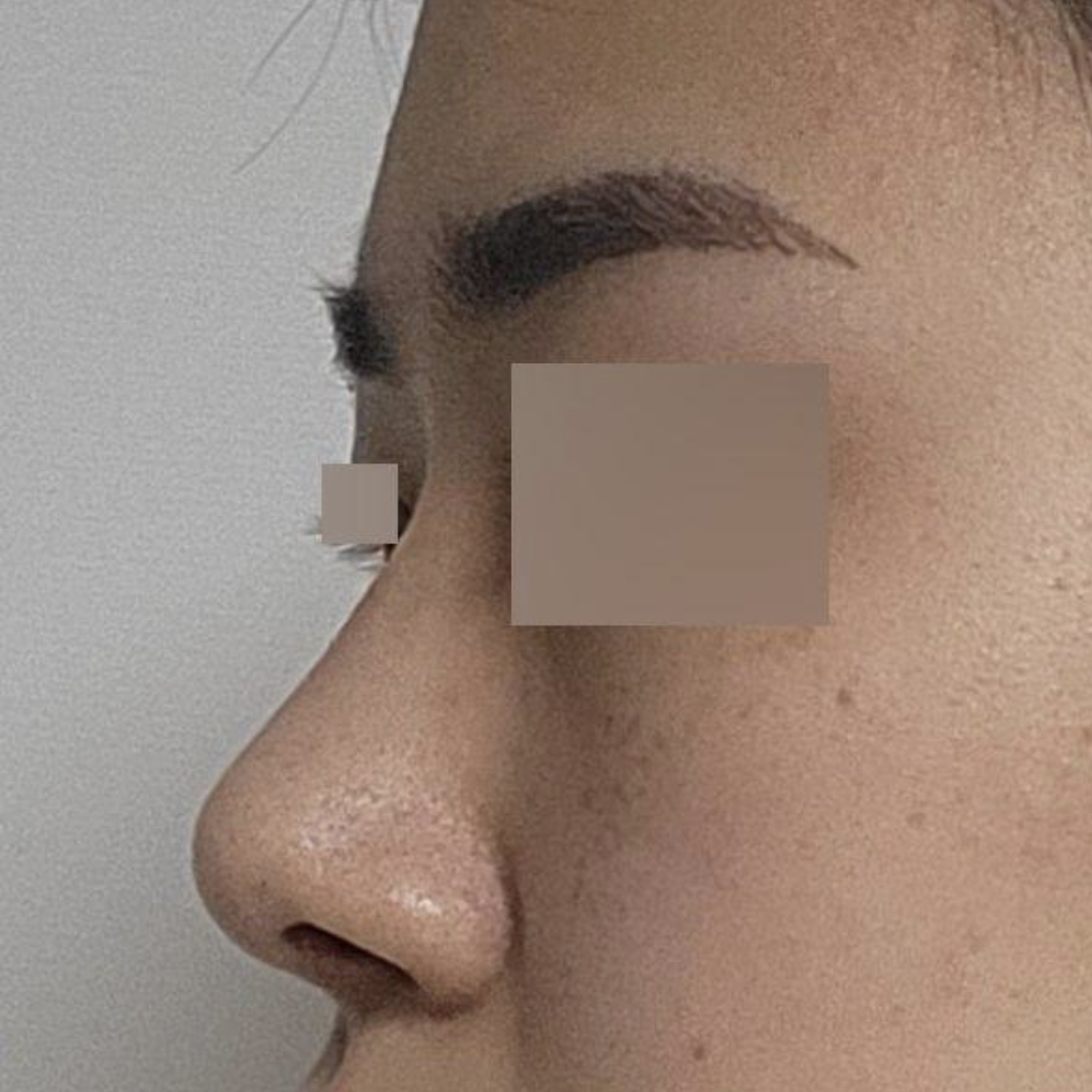 手術已經三個月了。