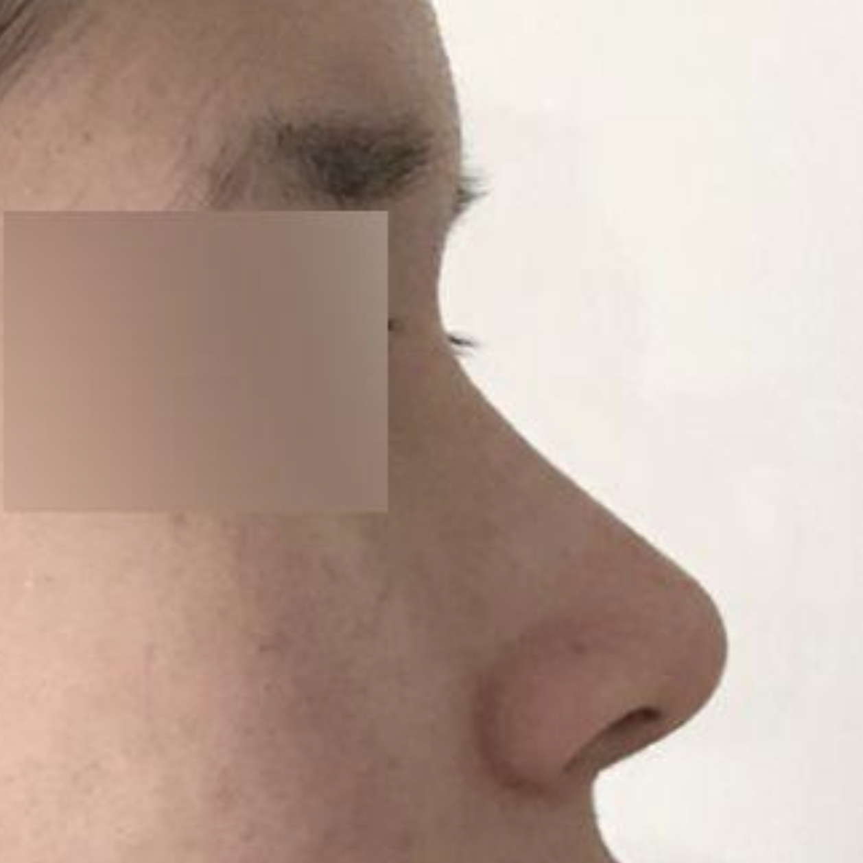 隆鼻手術後3個月後記！