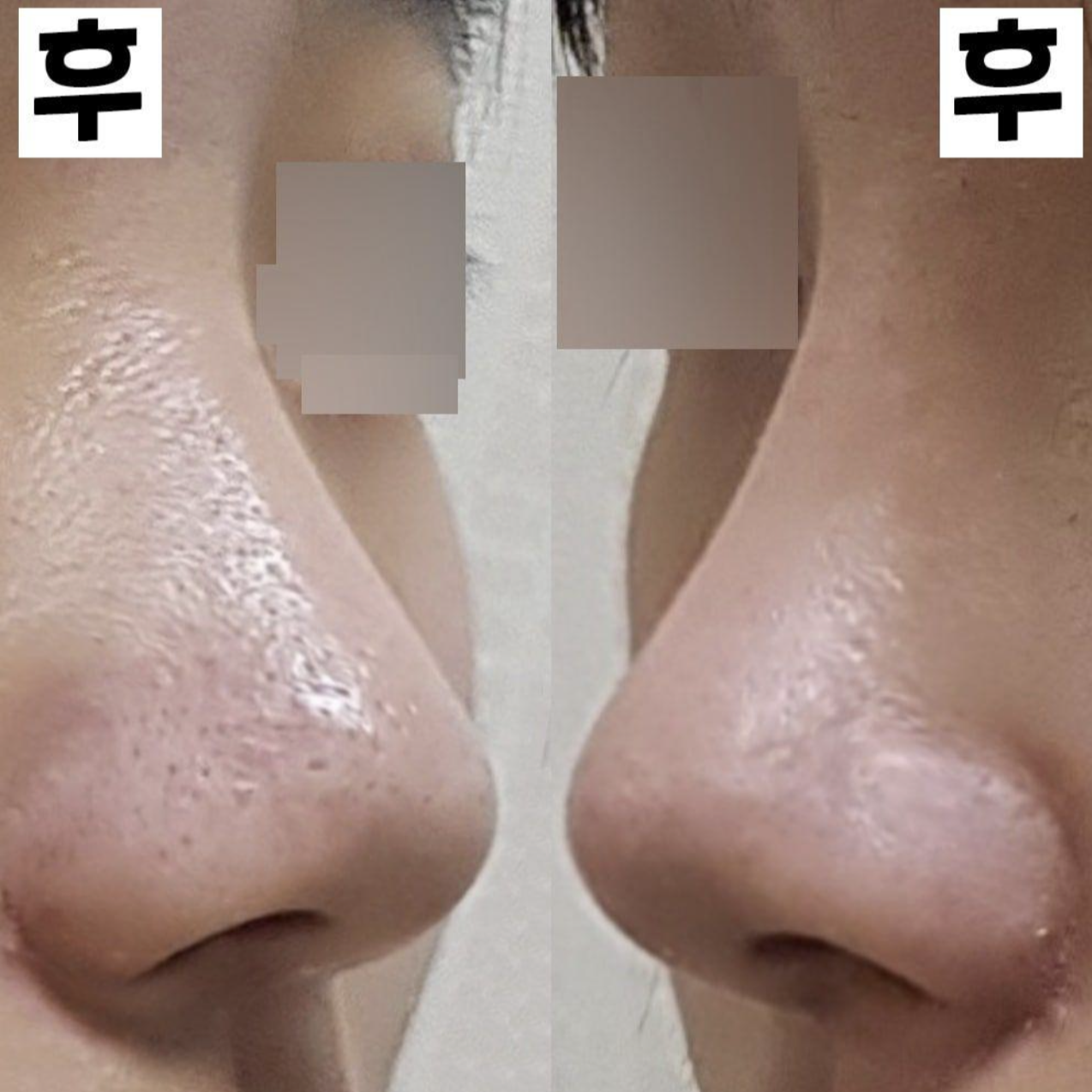 第一次做隆鼻手術已經兩週了！