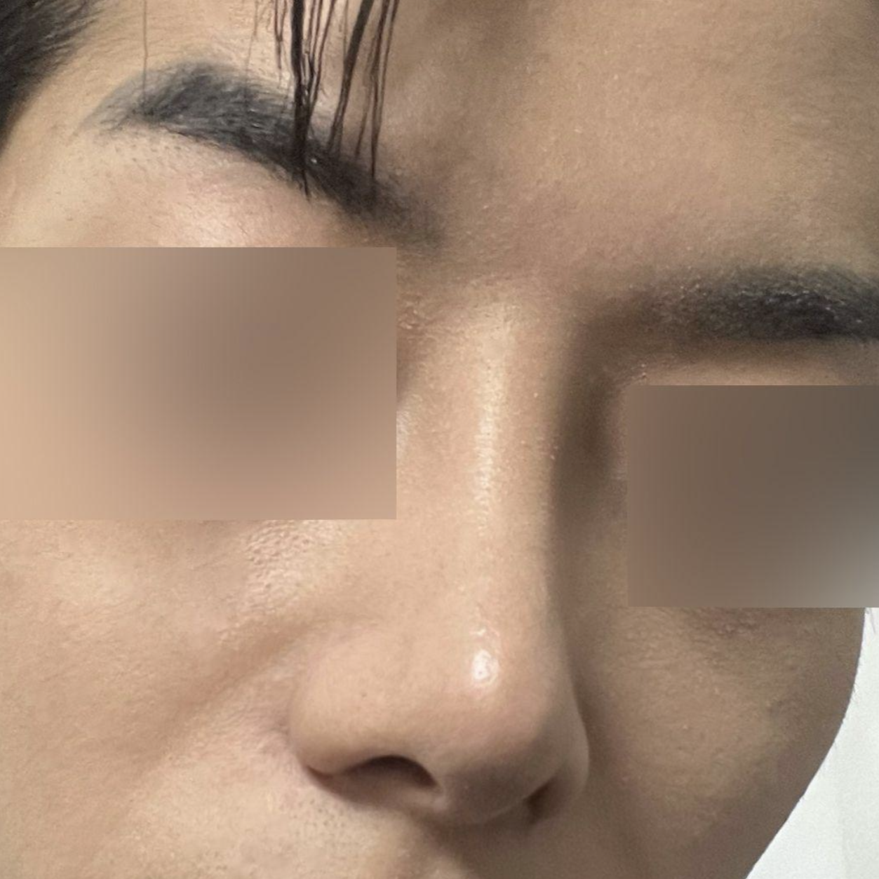 大鼻頭重修手術真的很滿意。