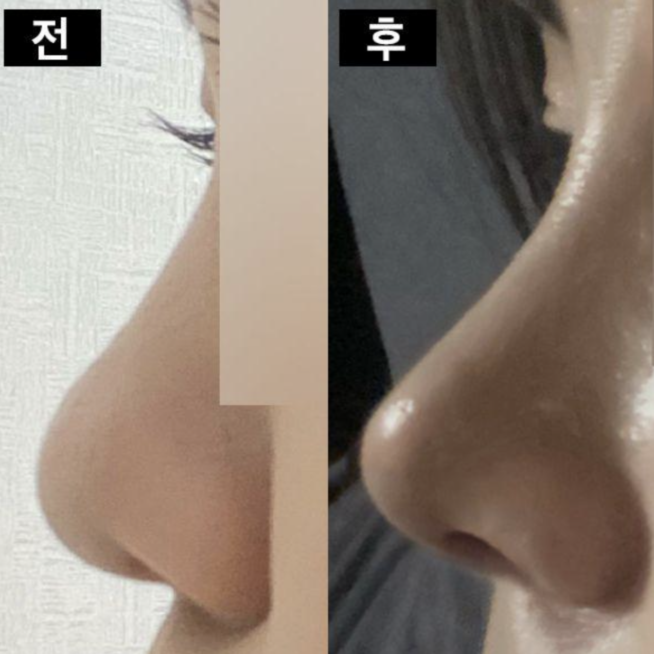 做完隆鼻手術已經1個月了 ㅎ