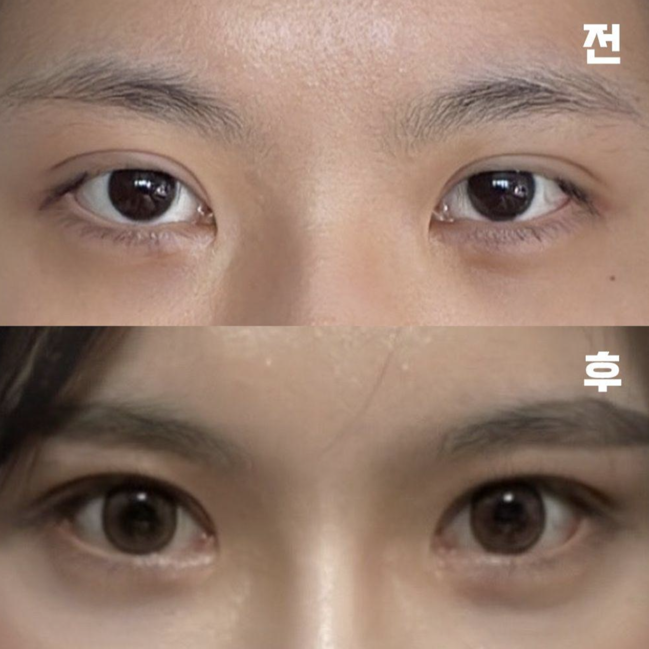 已經開始期待消腫後的樣子