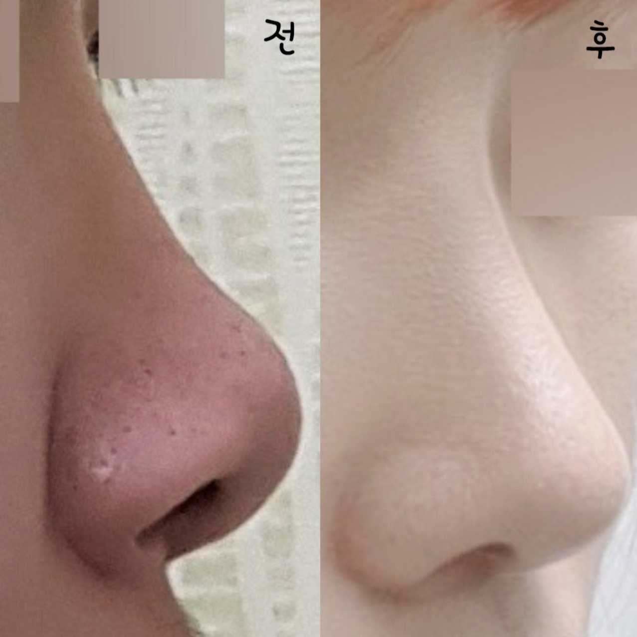 手術後，我變得更有自信了！！