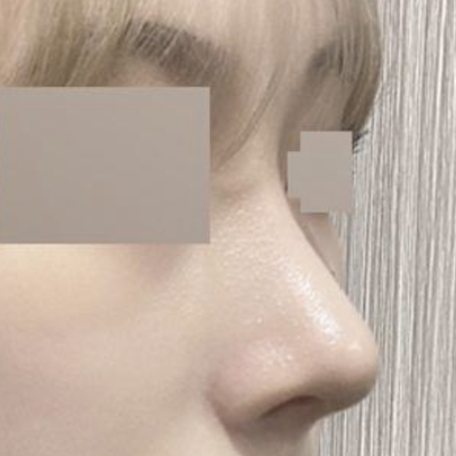 已經手術兩個月了！！