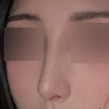 因為鷹鉤鼻壓力很大，下定決心做了手術！！