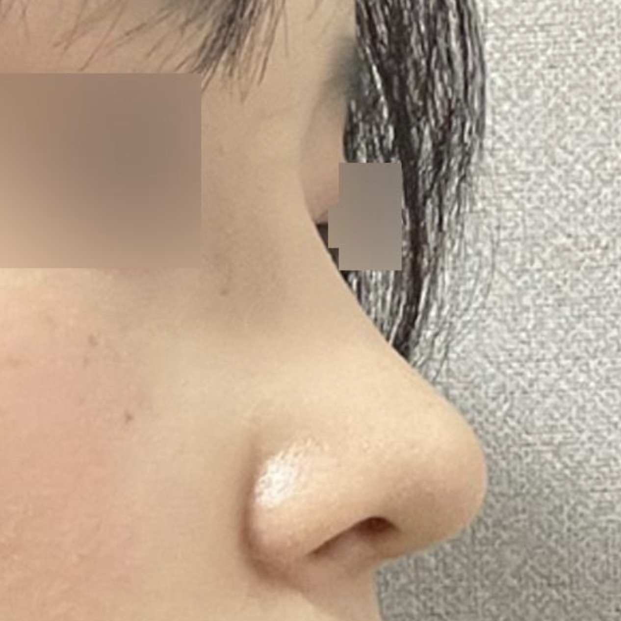 手術做得太好了，我非常滿意！