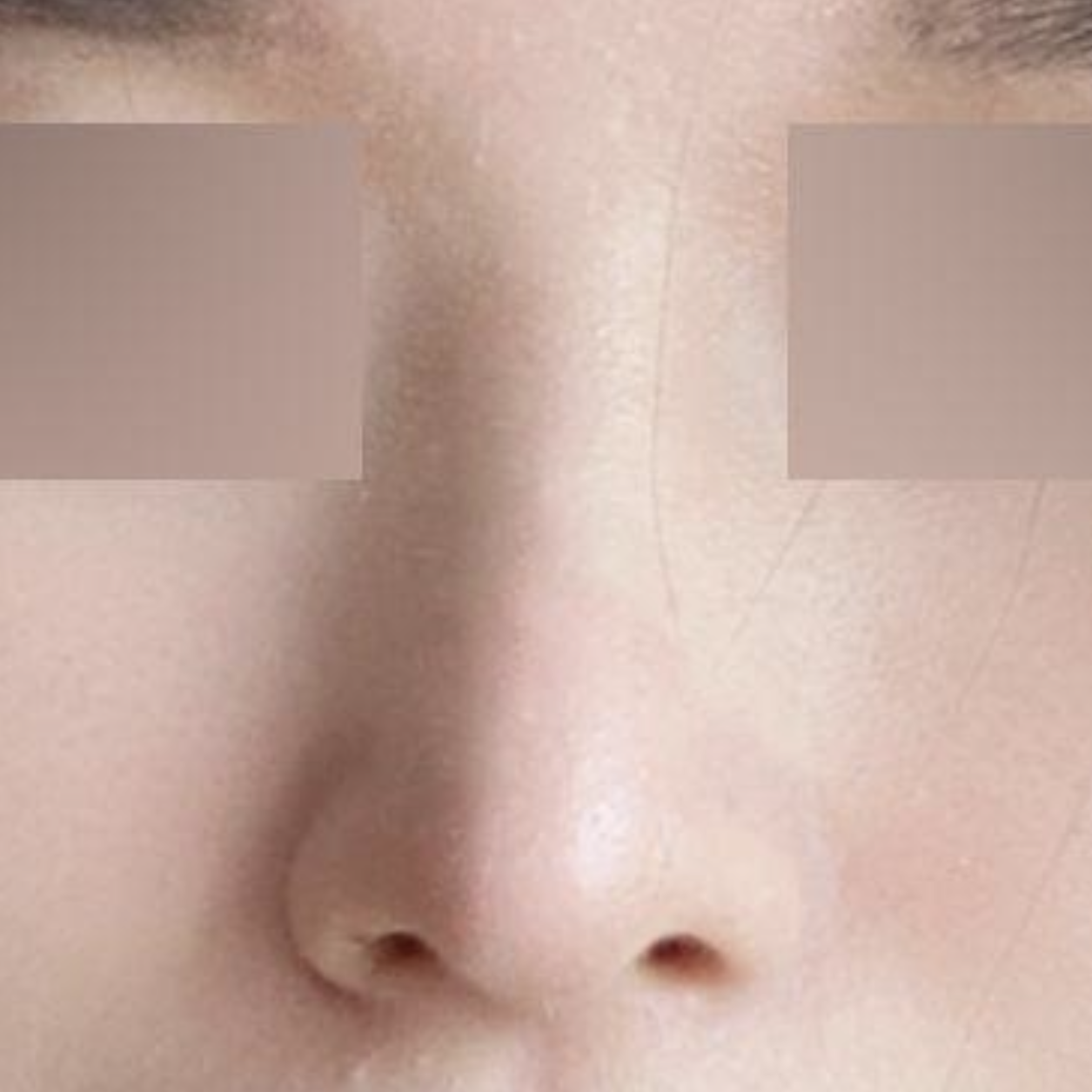 做完隆鼻手術已經6個月了