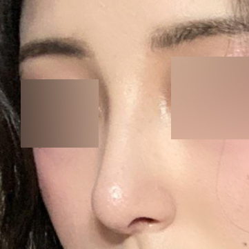 手術後一個月了。