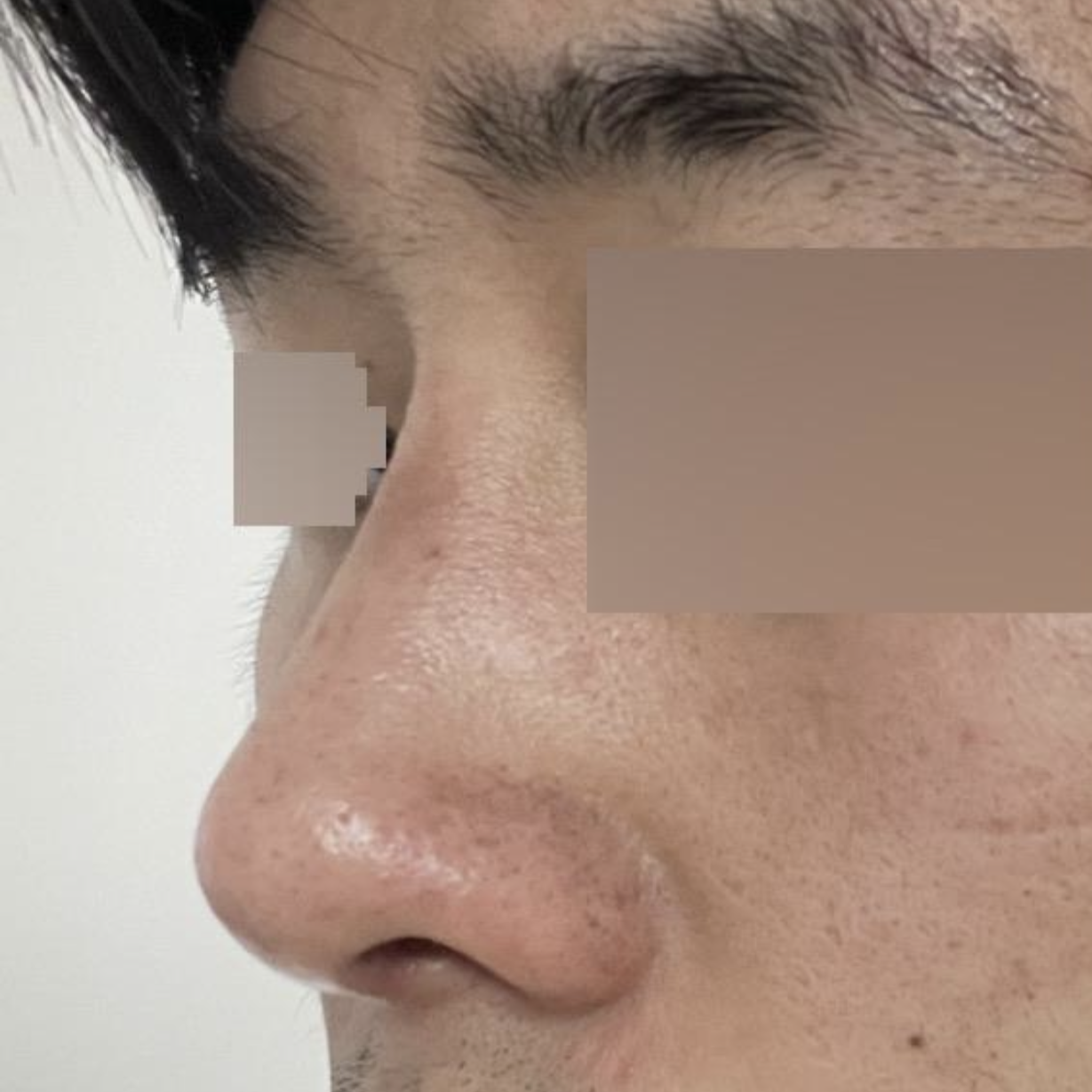 期待消腫後更加自然