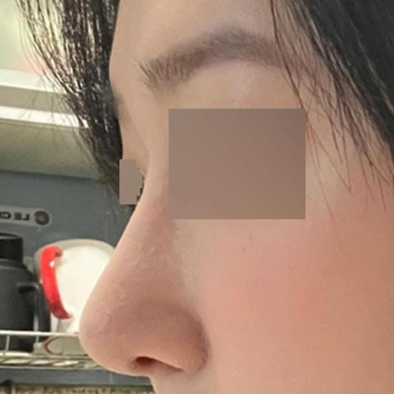 第一次做鼻部手術，到處 고민하다 終於做了鼻子手術。