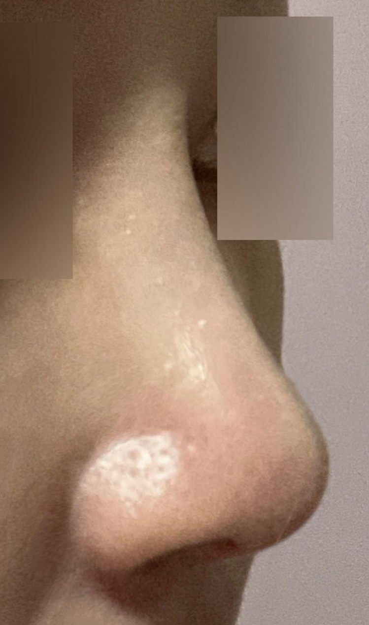 手術已經過去6個月了