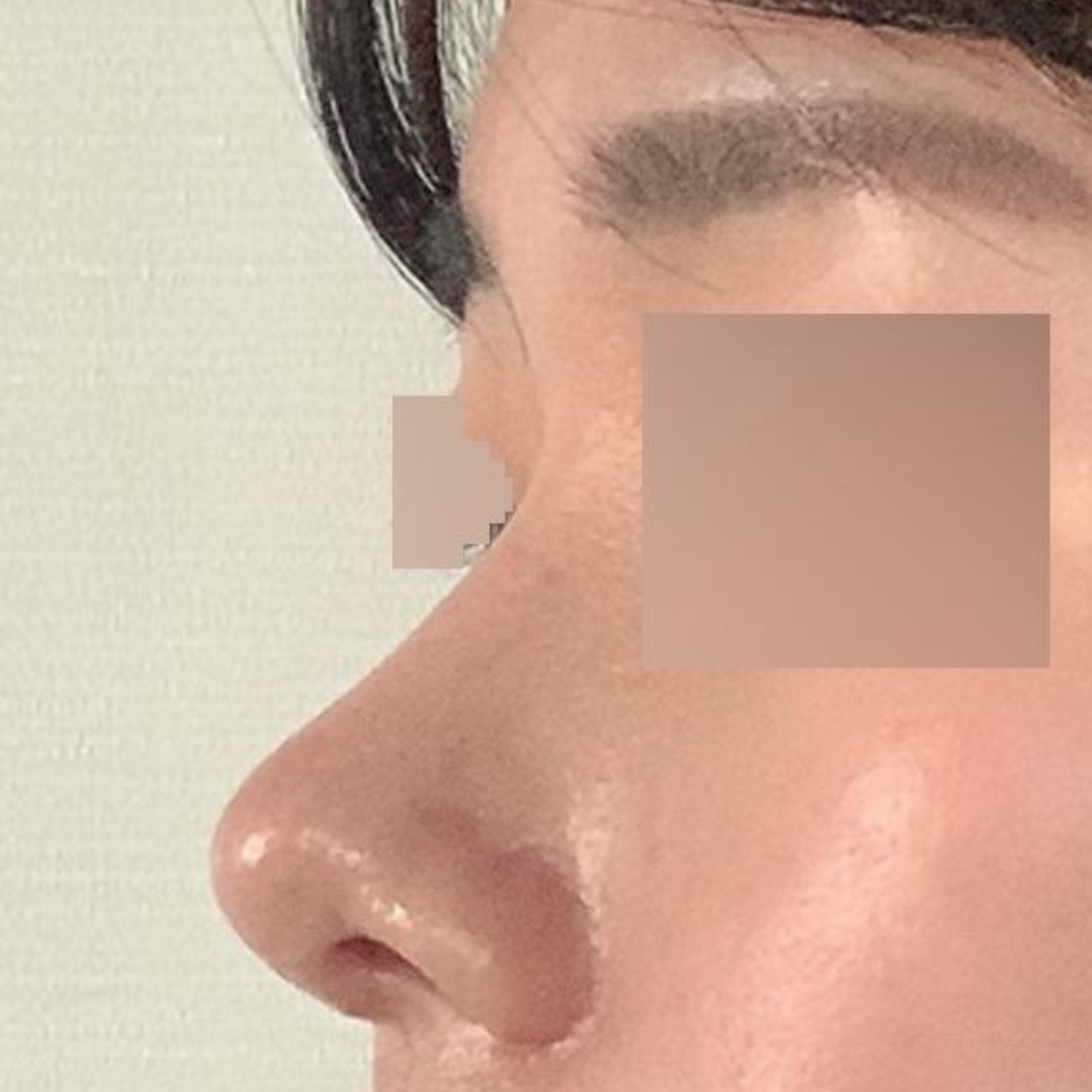 在WiiVerse整形外科做眼鼻手術一個月後的後記！！