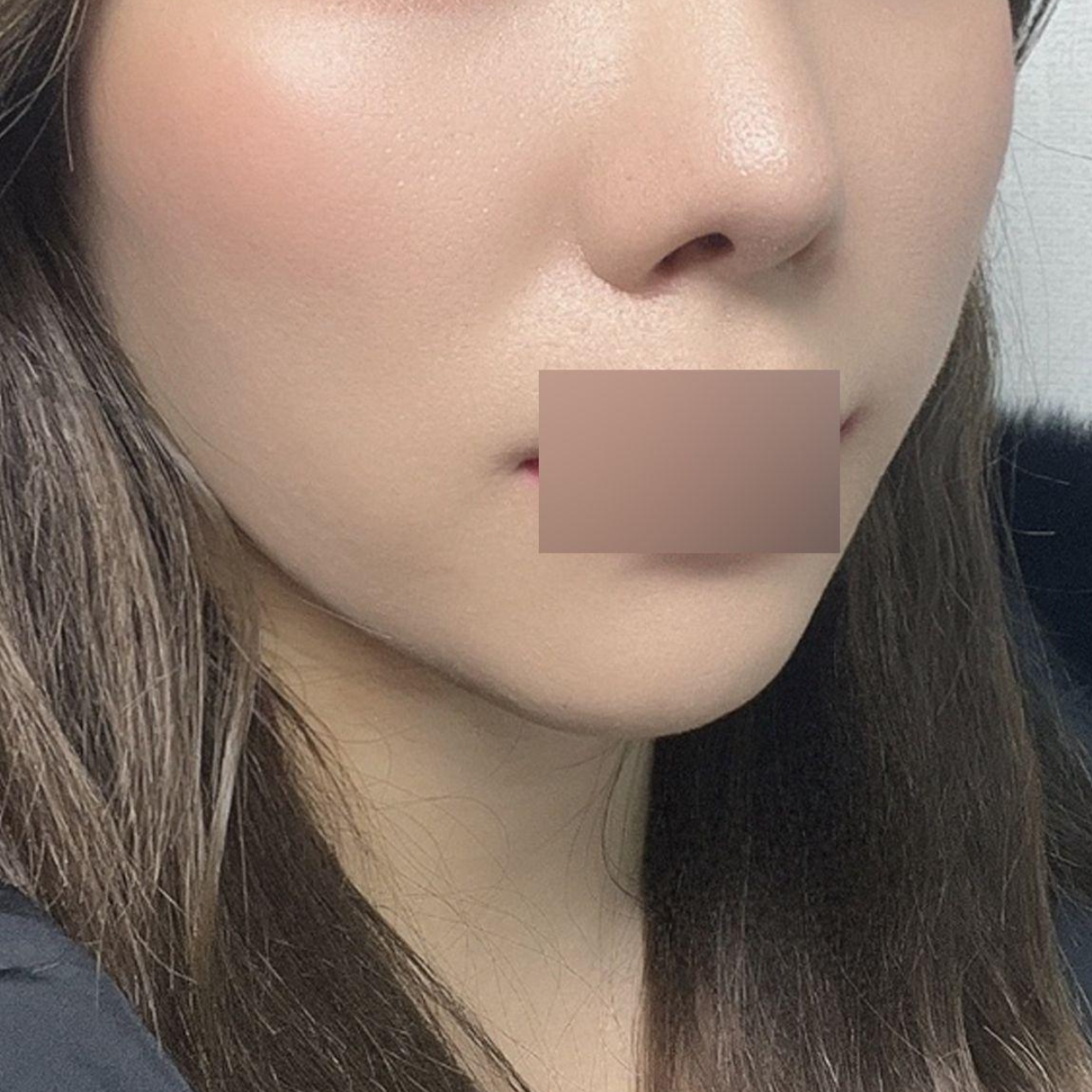 蜜桃線雕拉提3個月後記