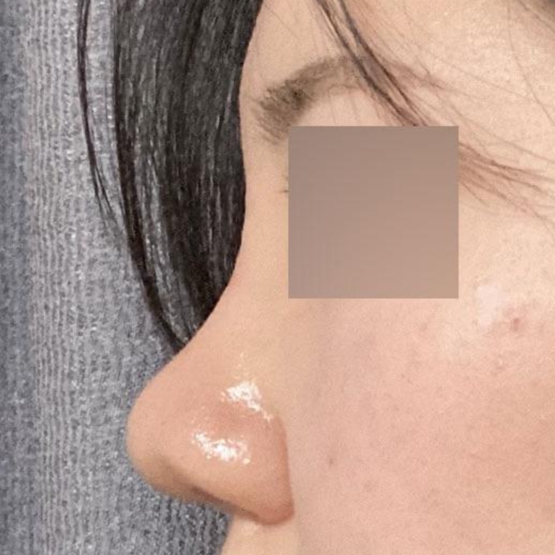 手術後1個月的後記。我在韋伯斯整形外科找沈正煥院長做了隆鼻手術！