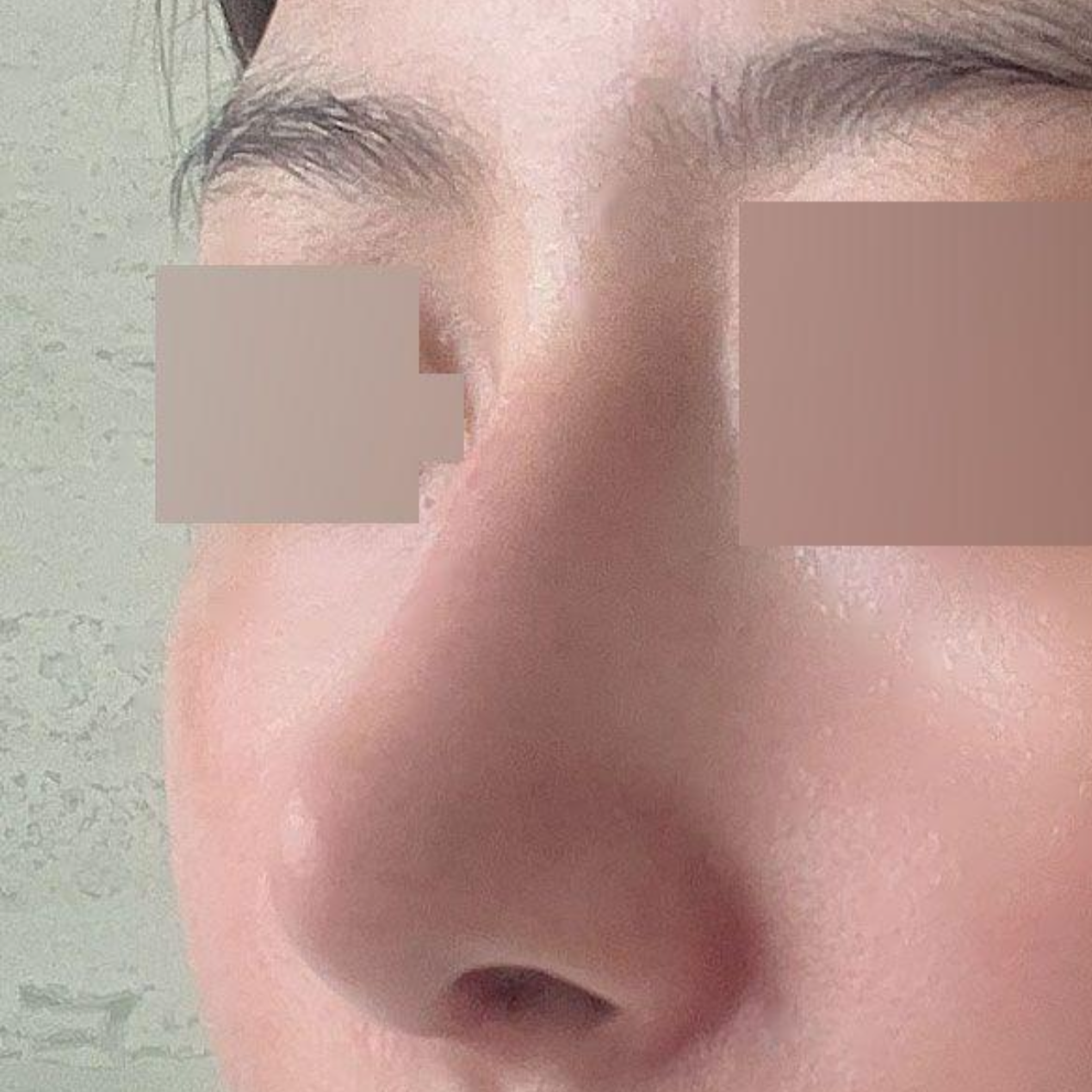 感謝徐承祖院長，讓我的鼻子重獲新生！