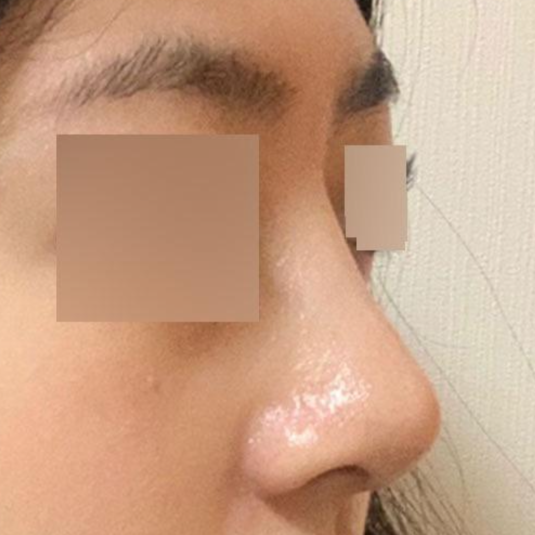 給徐承祖醫生手術的一個月後記。