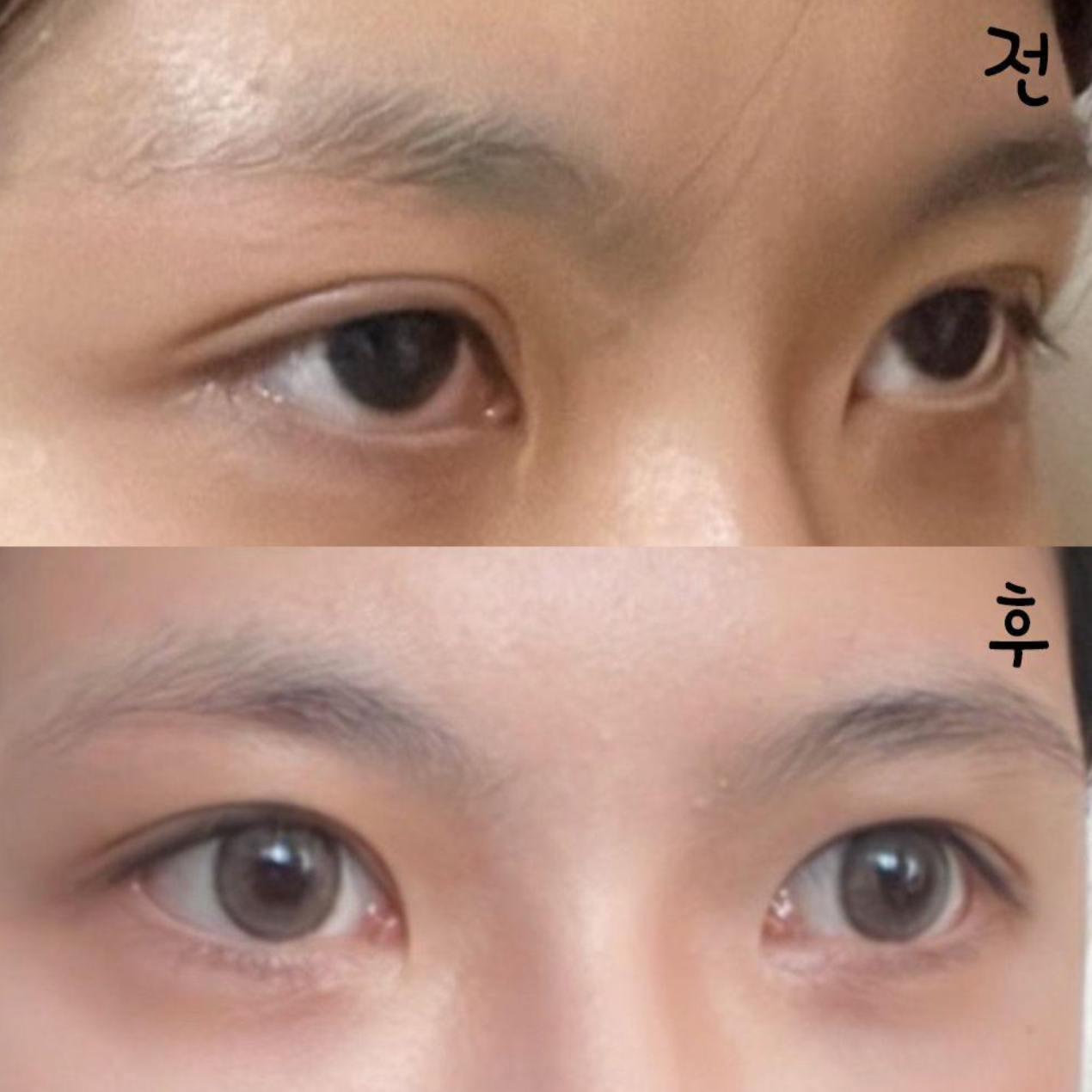 在江南站 Weavers 整形外科做眼部重修手術已經兩個月了！