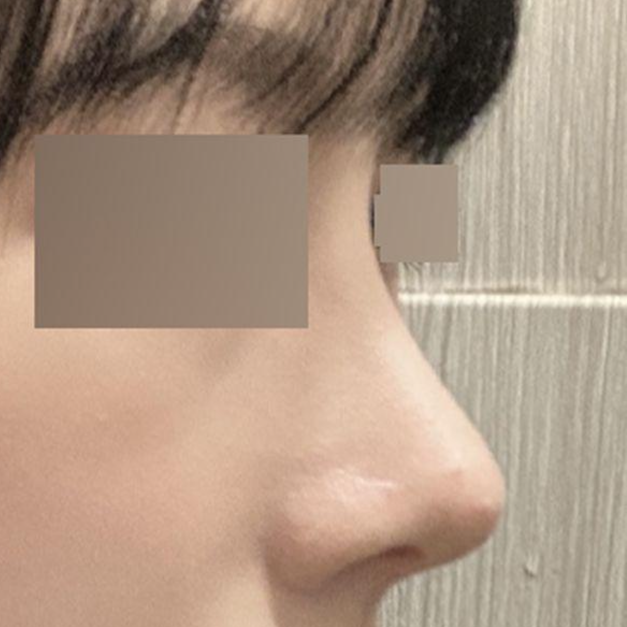 做了鷹鉤鼻手術已經3個月了！