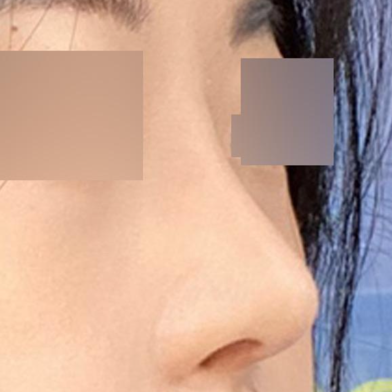 手術已經兩個月了，非常滿意。