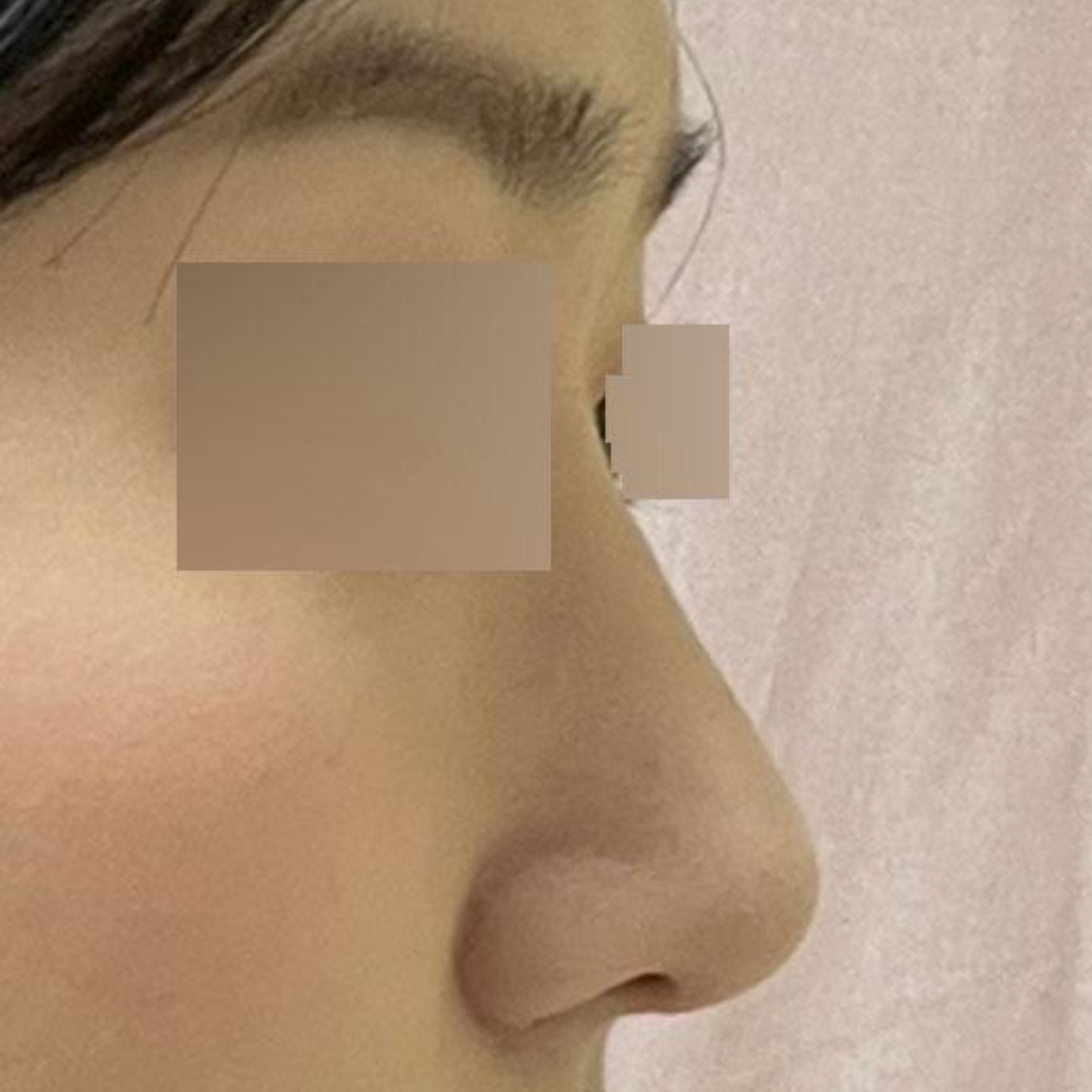 非常滿意你給我做的新鼻子，哈哈