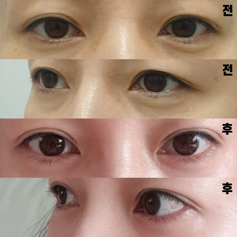 再次覺得做手術是正確的選擇